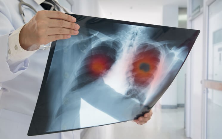 Inmunoterapia Contra el Cáncer