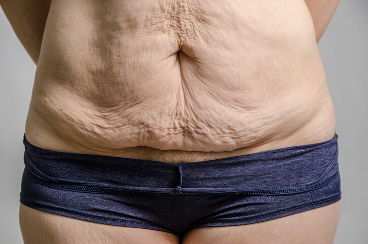 Abdominoplastia