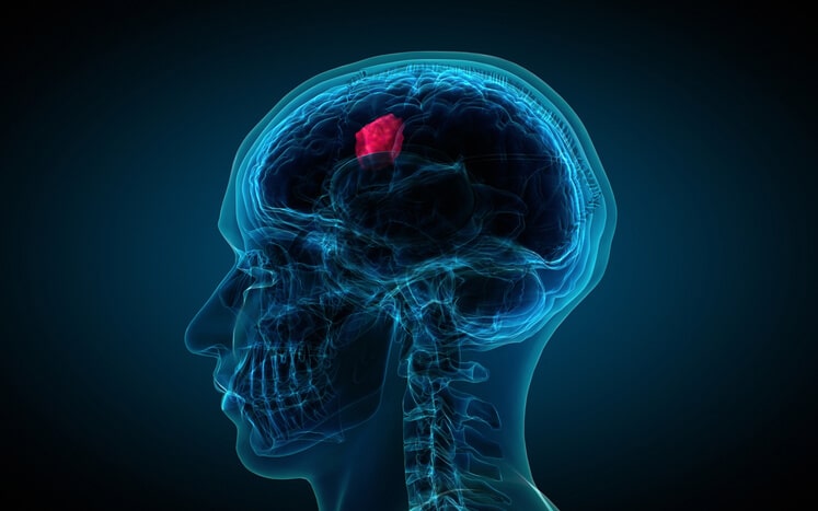 Operación Tumor Cerebral