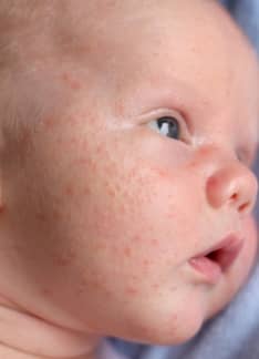 Queratosis pilaris: síntomas y tratamiento