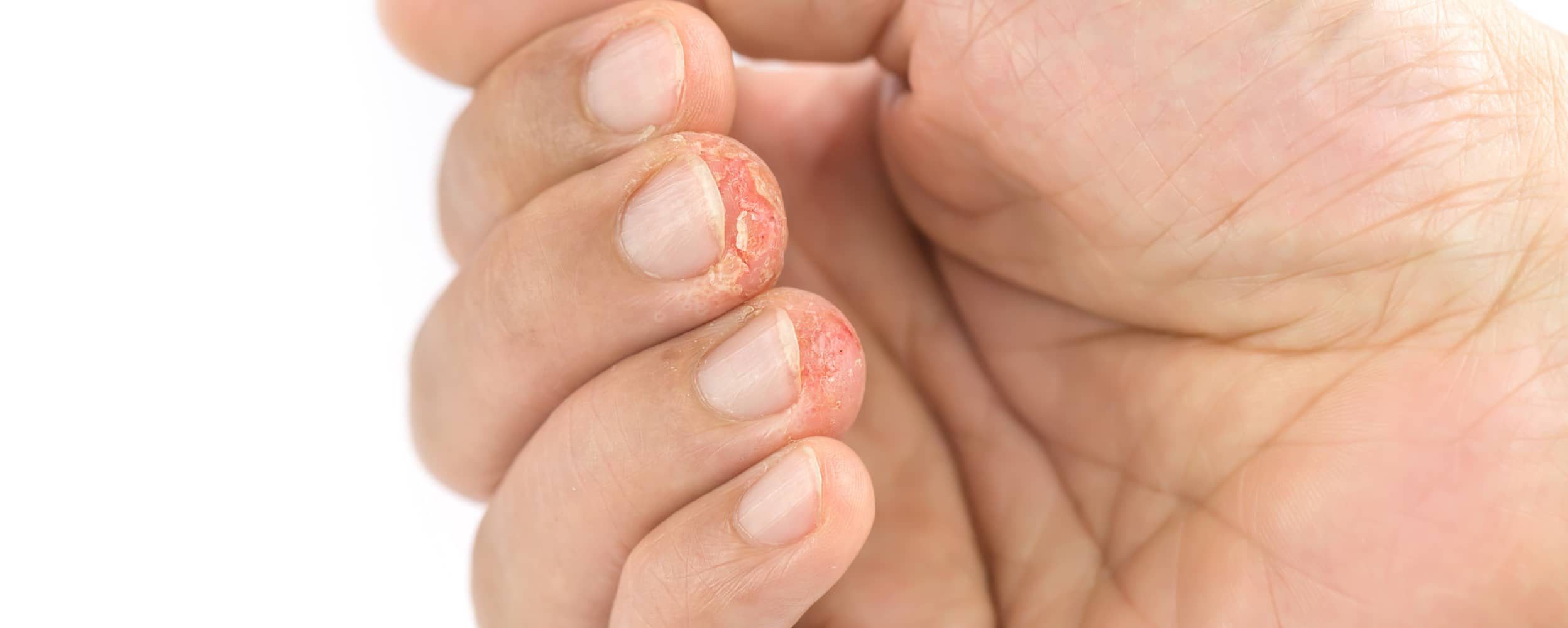 Dishidrosis en las manos: ¿Por qué aparece?