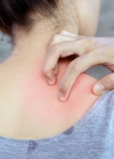 Alergia al sudor y cómo identificarla
