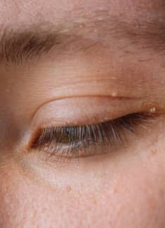Siringomas: ¿Por qué salen y cómo se tratan?