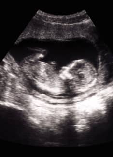Ecografía de las 20 semanas: ¿Qué detecta?